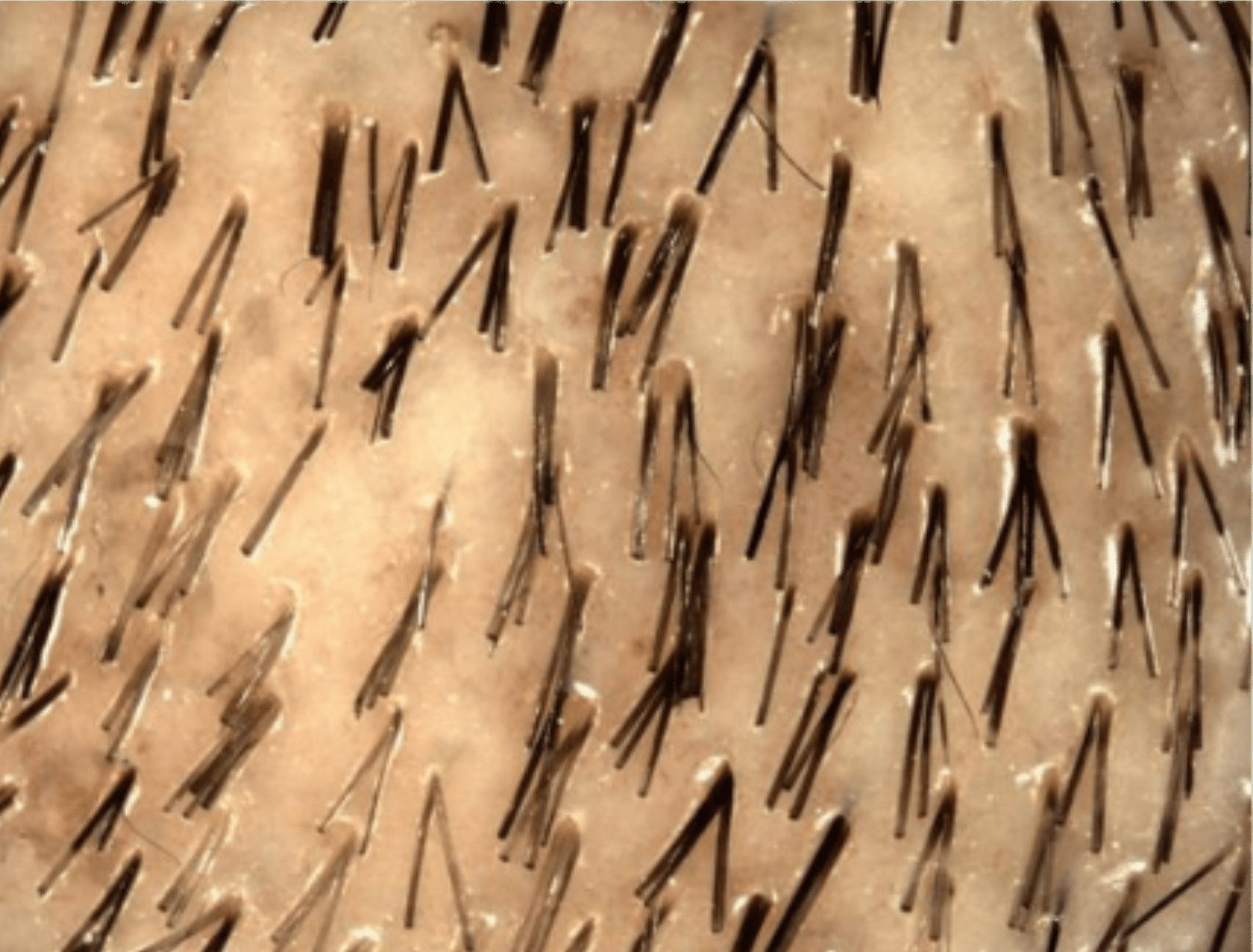 Nahaufnahme der Kopfhaut mit spärlicherer Haardichte; viele Follikel mit 1–2 dünnen Haaren.