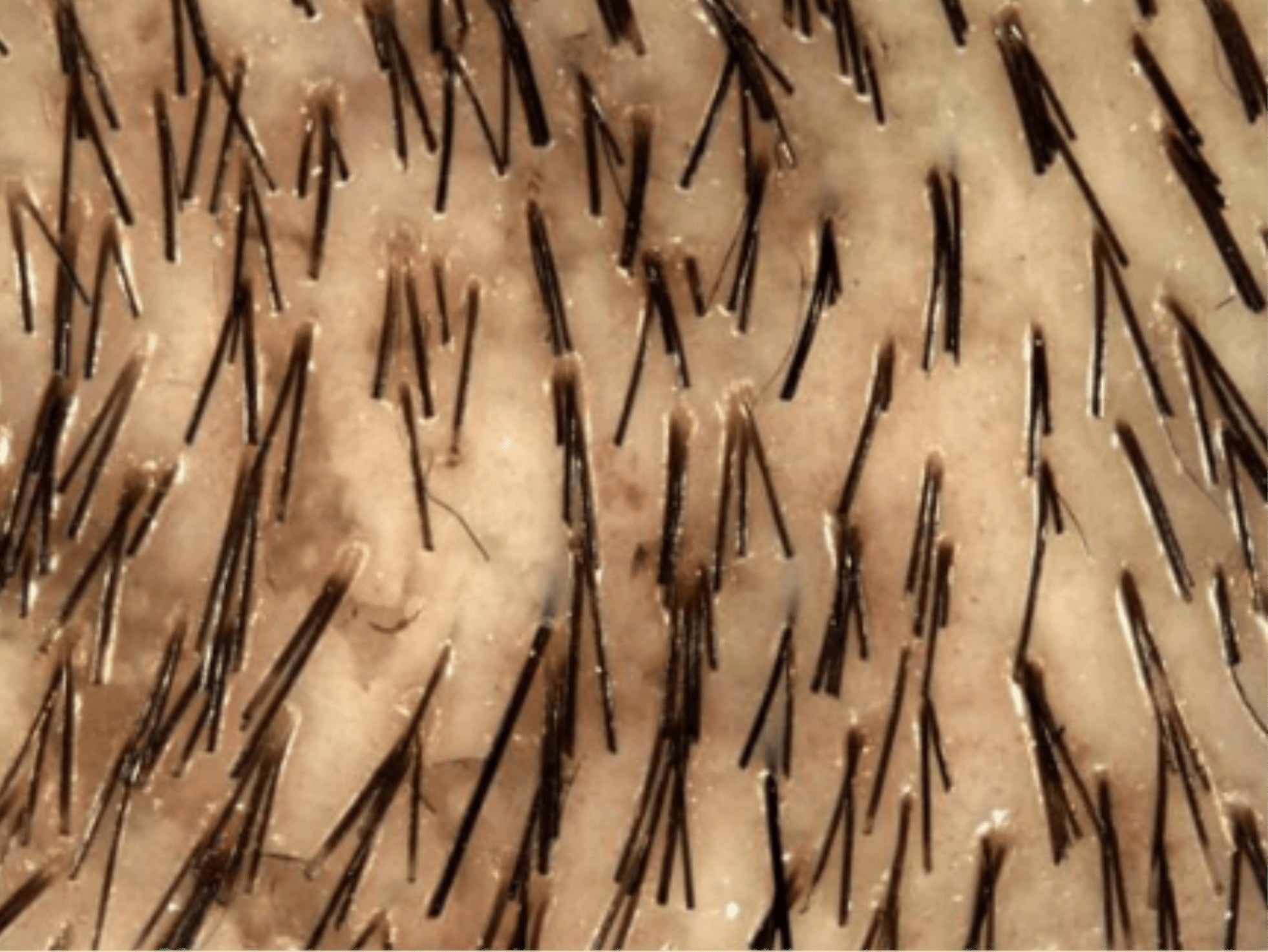 Nahaufnahme mit mittlerer Haardichte; mehr Follikel tragen 2–3 Haare.