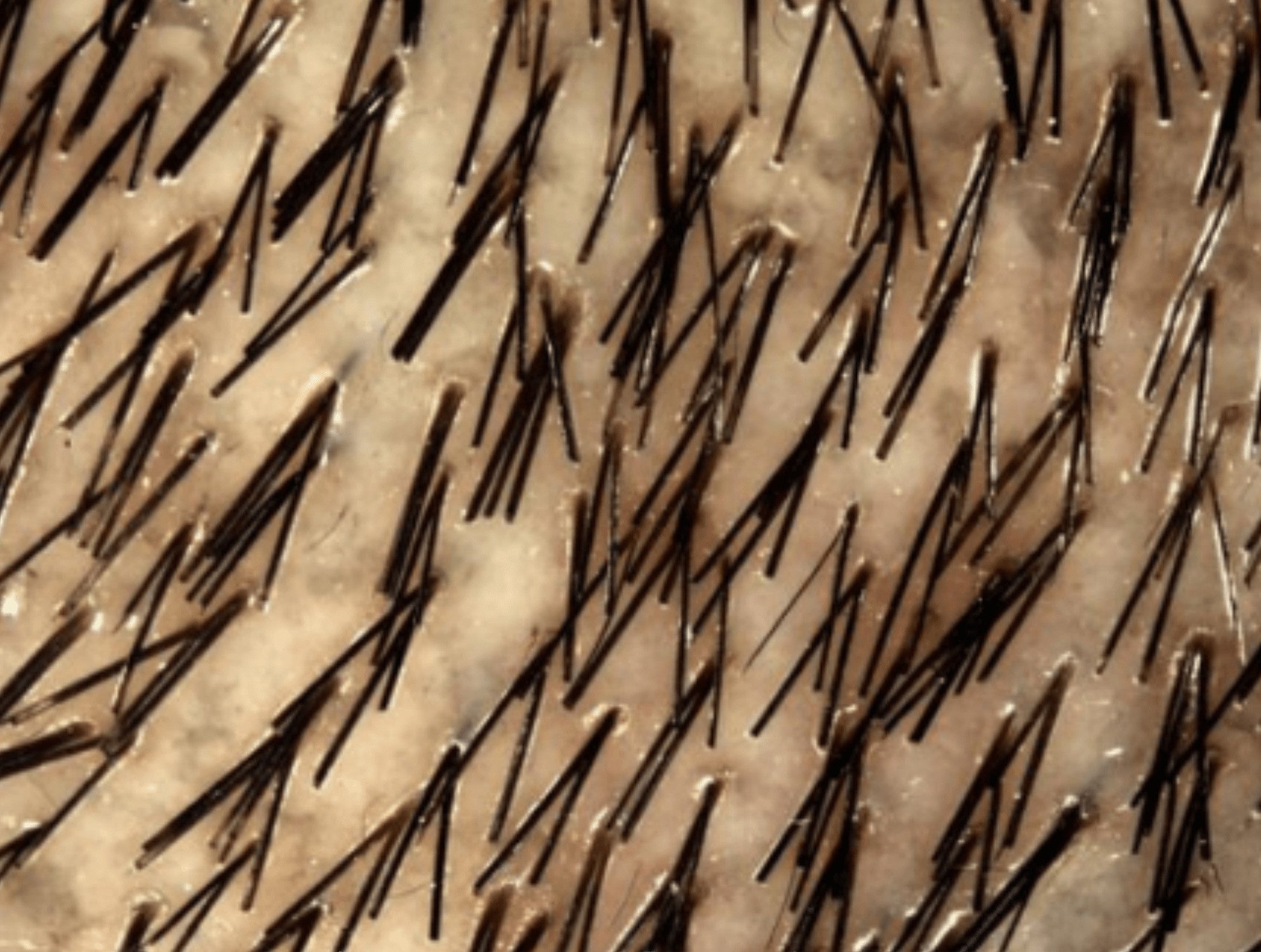 Nahaufnahme mit höherer Haardichte; zahlreiche Follikel mit 3+ Haaren, dichteres Erscheinungsbild.